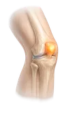 Knee Pain
