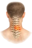 Neck Pain