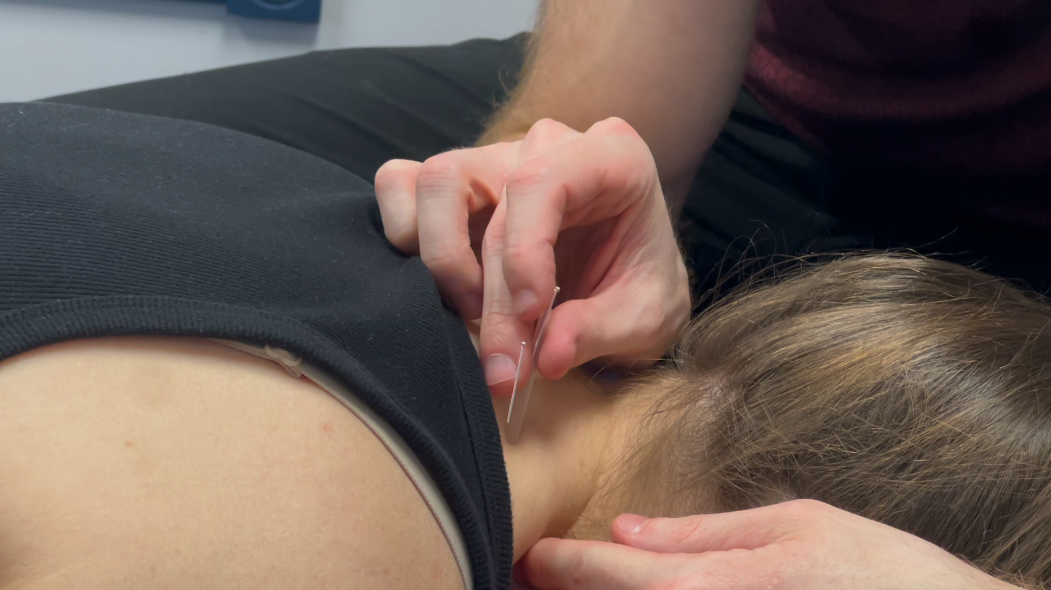 Close-up of dry needling treatment
